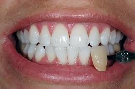How to whiten you teeth after braces? Teeth Whitening Bristol Zoom Laser Whitening Bristol Whiter Teeth