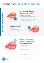 Ein Lebenslanger Begleiter Der Lippenherpes Herpes Labialis Pta Digital