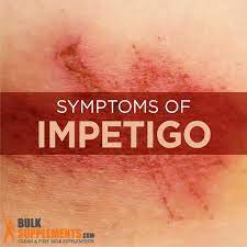Impetigo: Symptoms, Causes & Treatment |