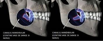 Te invatam ce sa faci atunci cand te doare un dinte si nu poti ajunge la stomatolog pentru a trata durerea sacaitoare. Simptome Eruptie Implantodent