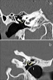 Image result for Ossicular Chain Disruption