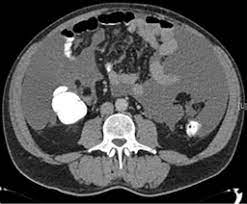 Doctors also use mesothelioma blood tests to measure treatment response. Ct Scan Showing Diffuse Peritoneal Mesothelioma Download Scientific Diagram