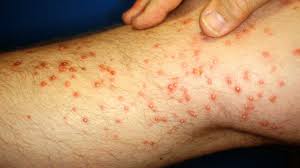 Image result for Fire Ant Sting