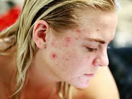 The most common acne questions answered: 'Don't prod it, press it or prick  it'