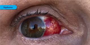 Image result for Hyphema