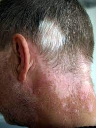 Following aa, regrowth of white hair is often seen in areas that were previously filled with darker hair. Poliosis Wikipedia