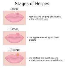Image result for oral herpes symptoms roof of the mouth