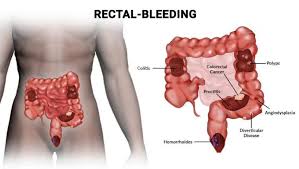 Image result for Blood in stool