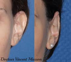 L'otoplastie est une plastie de l'oreille qui vise à corriger une malformation au niveau de l'intervention peut se faire sous anesthésie locale pour les adultes ou générale pour les enfants, selon la tolérance du patient, son désir, la concertation. Oreilles Decollees Et Otoplastie Chirurgie Esthetique Paris