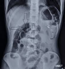 Image result for Midgut Volvulus