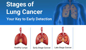 Image result for Lung Cancer