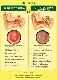 Image result for Acute Otitis Externa