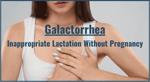 Image result for Galactorrhea