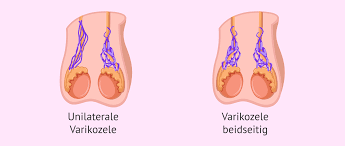 Testicularis entsteht eine varikozele (hodenkrampfader). Kann Eine Schwangerschaft Bei Einer Hodenvarikozele Erreicht Werden