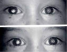 Anisometropic Amblyopia 5 Year Old Male With Unequal Vision Pediatric Ophthalmology Eye Health 5 Year Olds