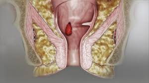 Thrombosed hemorrhoids may present as a single lump or a circle of lumps. Thrombosed Hemorrhoids Archives Foreign Policy