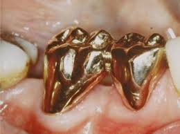 Ob und wann ein weisheitszahn gezogen werden muss, erfahren sie im nachfolgendem inhalt. Zahnerhalt Versus Implantat Steht Jeder Naturliche Zahn Einem Implantat Nur Im Wege Fachportal Fur Wehrmedizin Wehrpharmazie