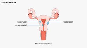 Uterine fibroids are almost never cancerous, and they don't increase your risk for getting other types of cancer. Fibroids Causes Symptoms Treatment And Types
