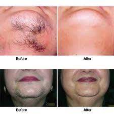 Watch as i use olay facial hair removal duo to remove the hair on my face. 12 Laser Treatments Ideas Skin Treatments Treatment Laser Therapy