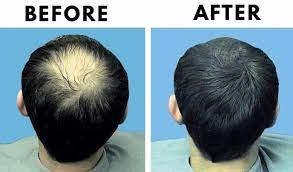 Other names for this type of hair loss are androgenetic alopecia, female pattern hair loss, female it is very important to have ample amounts of protein in your diet if you want to avoid hair loss. How To Stop Hair Loss 10 Easy Proven Ways To Cure Baldness