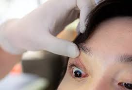 Image result for Conjunctivitis Resources