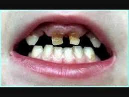 We did not find results for: Rotten Teeth Youtube