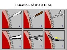 Image result for Small Caliber Chest Tube