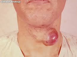 Image result for Dermatofibrosarcoma Protuberans