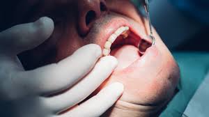 It can be the result of an incident that happened many years ago. A Dentist Sees More Cracked Teeth What S Going On The New York Times