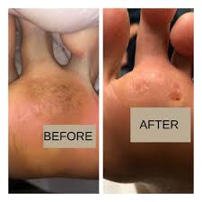 Aliexpress carries many warts removal wart related products, including skin tag cutter , laser device to remove , laser dot mole removal pen , mole removal pen wart , acne. Swift Microwave Therapy For Verruca Lesions