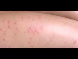 ظهور حبوب حمراء في الجسم مع حكة Youtube