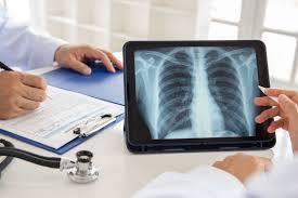 Image result for lung cancer xray