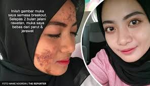 Cara hilangkan dark circle di mata seawal 7 hari →. Inilah Gambar Muka Saya Semasa Breakout Tapi Dah Pulih Selepas Jalani Rawatan Rm300 The Reporter