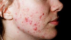 The blisters heal without scarring but they have a tendency to return. Cold Sore Vs Pimple Symptoms And Treatment