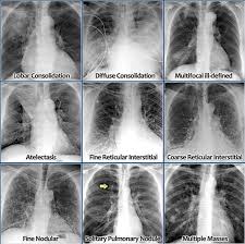 How To Identify And Differentiate Lung Diseases From Chest X Ray Medical Imaging Respiratory Therapy Radiology