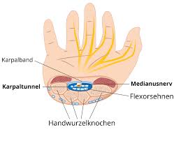 Karpaltunnelsyndrom Symptome Ursachen Und Behandlung
