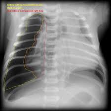 Image result for Pneumothorax