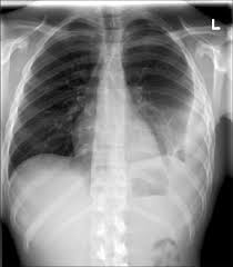Loculated pleural effusion treatment guidelines. Chest Radiograph Showing A Left Sided Loculated Pleural Effusion Download Scientific Diagram