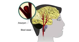 Emorragia cerebrale, quali sono le cause e le caratteristiche sintomatologiche di questa molto spesso si sente parlare di emorragia cerebrale, ma di fatto non sempre si sa di cosa si tratti di preciso. Come Nasce Un Emorragia Cerebrale La Repubblica
