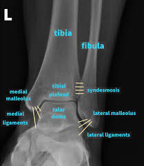 Image result for Ankle XRay