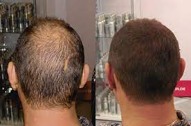 Kahle Stellen Super Million Hair