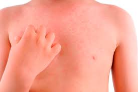 Ajutor vreau tratamente naturiste pentru aceasta boala de piele. BubiÈe Pe Piele Qbebe Ro