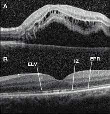 Thank you for visiting high country macula, retina, and vitreous, pc.all of our physicians, drs. Sd Oct In A Patient With Retinal Detachment Macula Off A Download Scientific Diagram