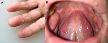 Telangiectasias are small, broken, or widened blood vessels found near the surface of the skin. Site Seeing Hereditary Hemorrhagic Telangiectasia With Native Valve Endocarditis The American Journal Of Medicine Blog