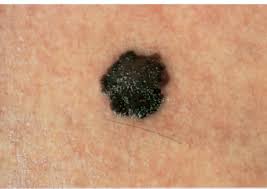There are rare melanomas that do not contain pigment and are flesh colored. Melanoma Warning Signs And Images The Skin Cancer Foundation