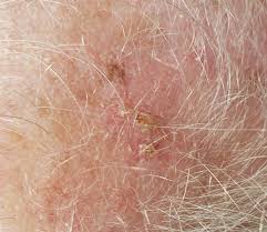The papules seldom appear on the hands and feet. Image Challenge Archive Penn State Journal Of Medicine