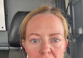 Hi, I am going to get blephs by oculoplastic surgeon and FL/NL by other  doctor. If anyone did like that separately, how far apart did you do? If  FL/NL first, the healing