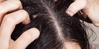 Acnes, a strain of bacteria that stimulates inflammation. Rosmarin Haarwasser Ist Ein Ausgezeichnetes Anti Schuppen Mittel Hair Dandruff Hair Loss Causes Dandruff
