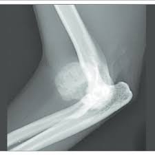 Symptoms of bone marrow cancer in cats bone marrow cancer will result in various symptoms, including localized pain, signs of bone weakness, signs of blood disorders, and potentially other issues if cancer has metastasized and spread to other parts of the body. Pdf Extraskeletal Osteochondroma On A Cat S Elbow