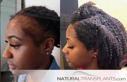 Women with female pattern hair loss rarely notice the issue prior to the age of 50, never go completely bald and never lose their hair lines. Best Hair Transplant Houston Texas Hair Replacement Experts